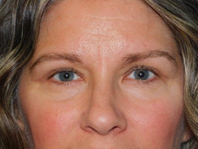 Blepharoplasty (Eyelid Lift) Before & After Gallery - Patient 160783531 - Image 2