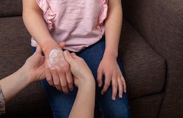 eczema