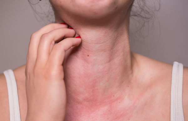 allergy