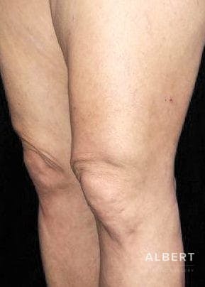 Knee Lift Before & After Gallery - Patient 151452133 - Image 3