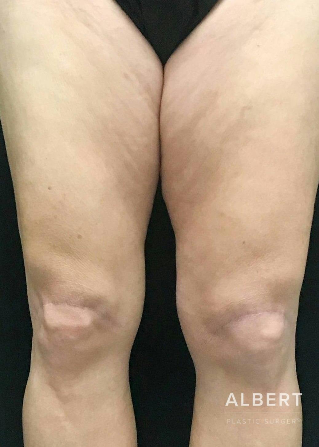 Knee Lift Before & After Gallery - Patient 151452133 - Image 2