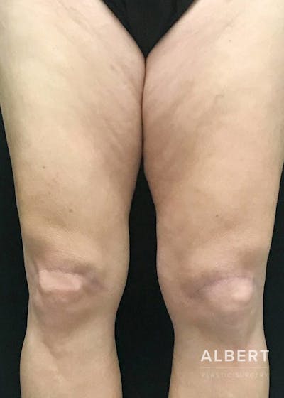 Knee Lift Before & After Gallery - Patient 151452133 - Image 2