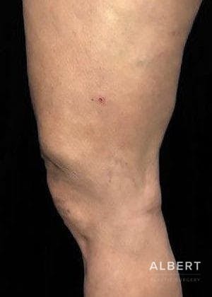 Knee Lift Before & After Gallery - Patient 151452133 - Image 5