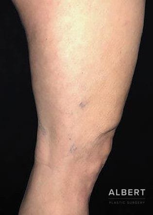 Knee Lift Before & After Gallery - Patient 151452133 - Image 9