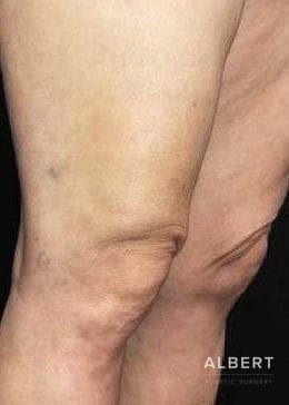 Knee Lift Before & After Gallery - Patient 151452133 - Image 7