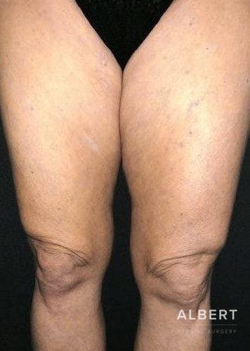 Knee Lift Before & After Gallery - Patient 151452133 - Image 1