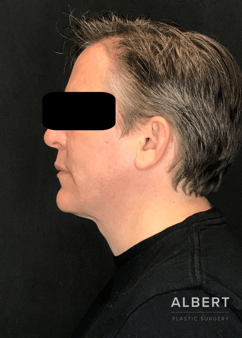 Liposuction Before & After Gallery - Patient 384585 - Image 4