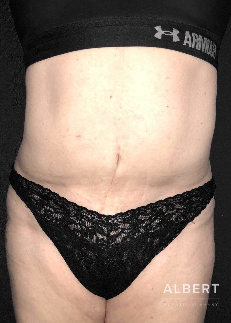 Liposuction Before & After Gallery - Patient 151452155 - Image 1