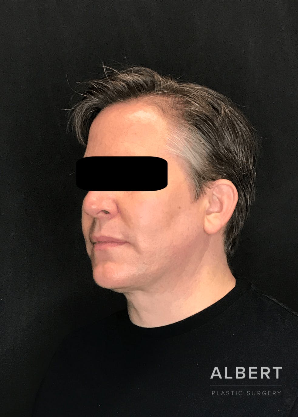 Liposuction Before & After Gallery - Patient 384585 - Image 2