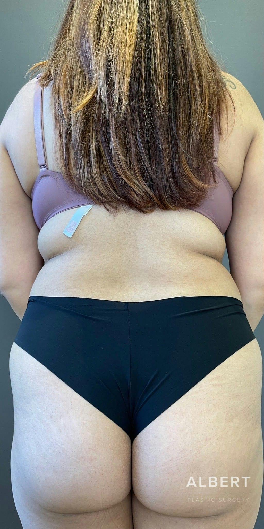Liposuction Before & After Gallery - Patient 151452145 - Image 1