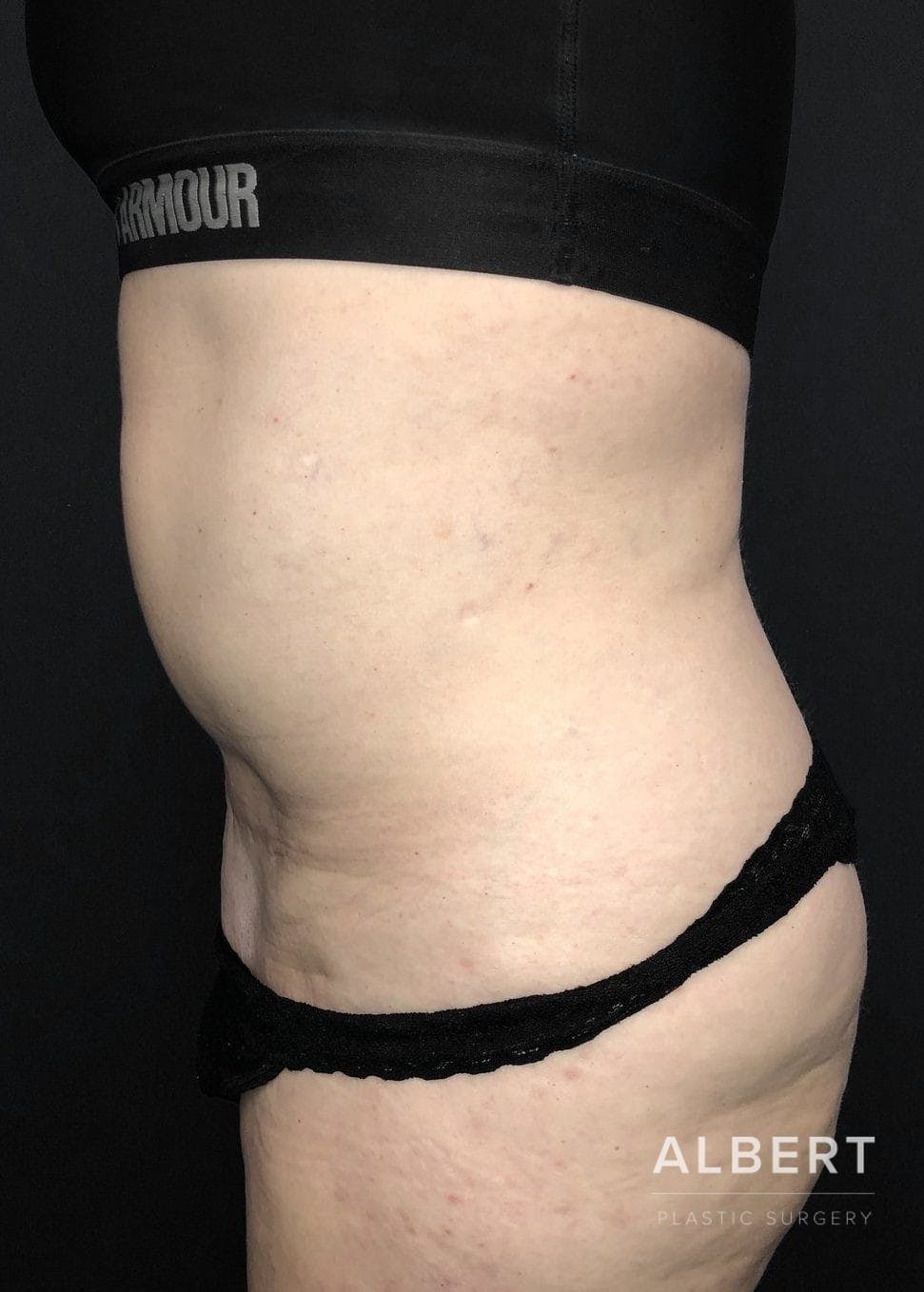 Liposuction Before & After Gallery - Patient 151452155 - Image 5