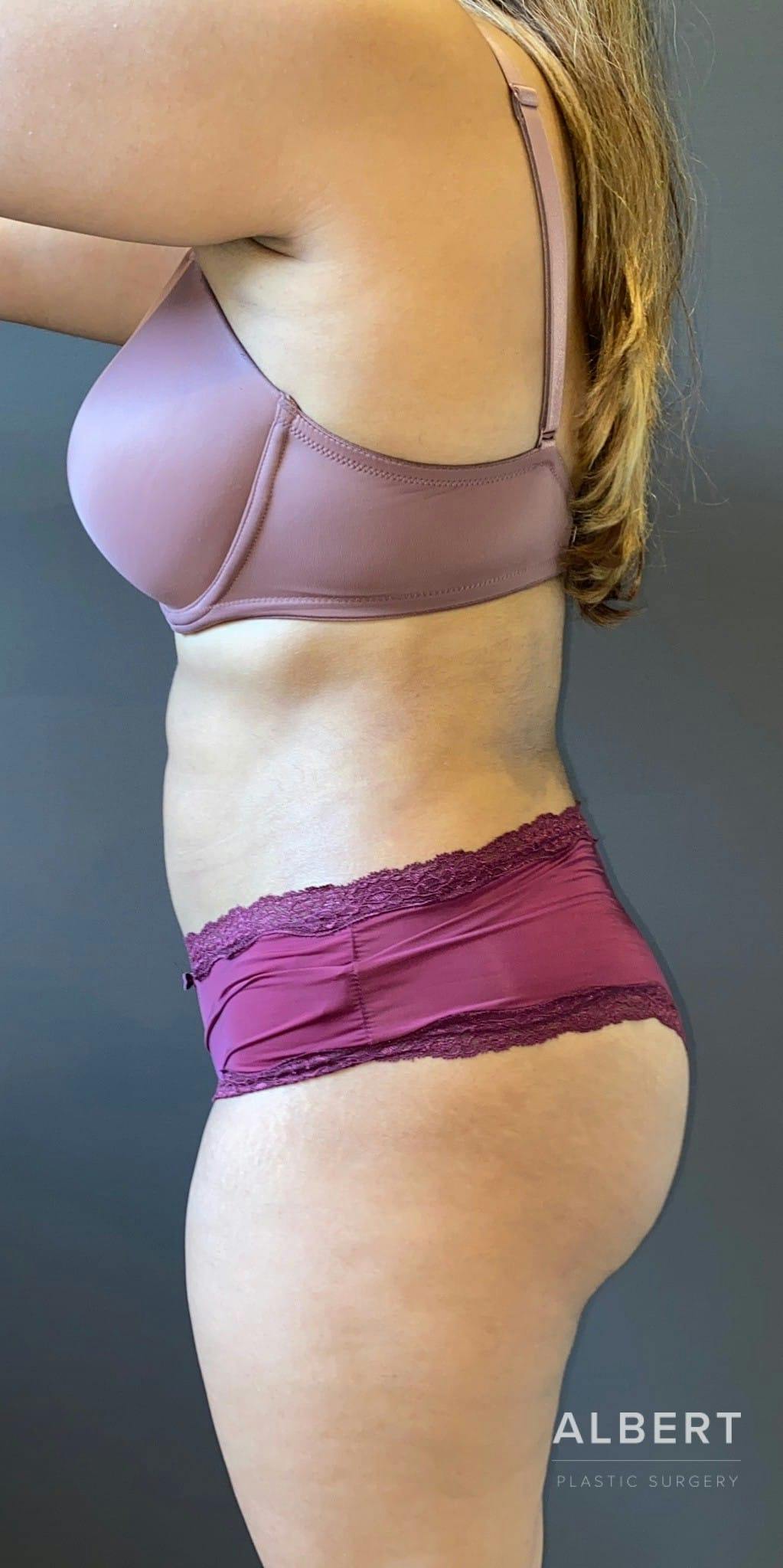 Liposuction Before & After Gallery - Patient 151452145 - Image 6