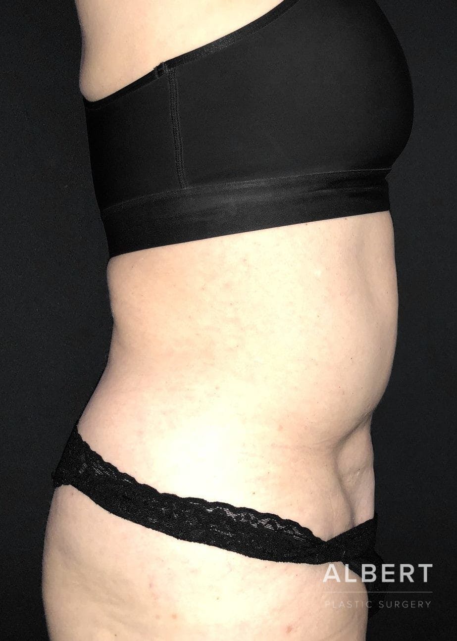 Liposuction Before & After Gallery - Patient 151452155 - Image 9