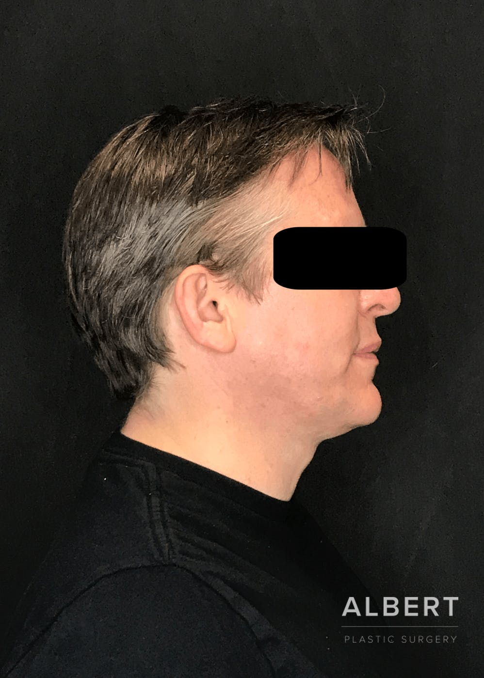 Liposuction Before & After Gallery - Patient 384585 - Image 6