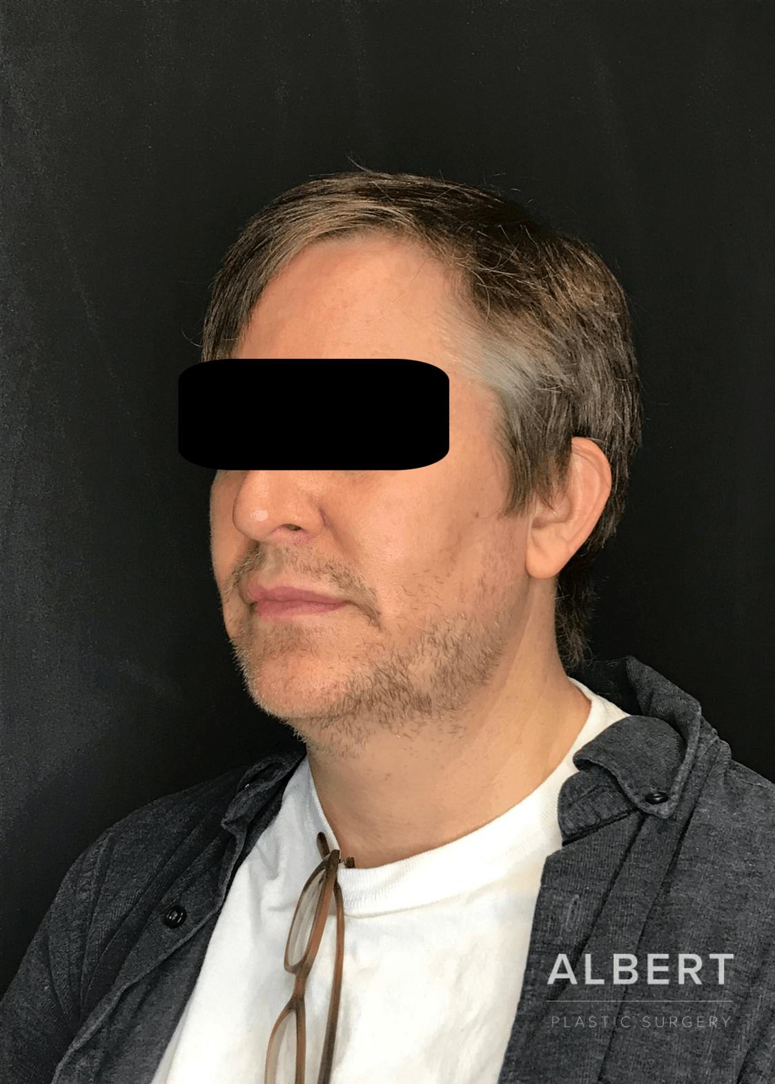 Liposuction Before & After Gallery - Patient 384585 - Image 1