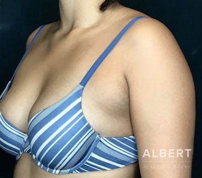 Liposuction Before & After Gallery - Patient 151452149 - Image 1