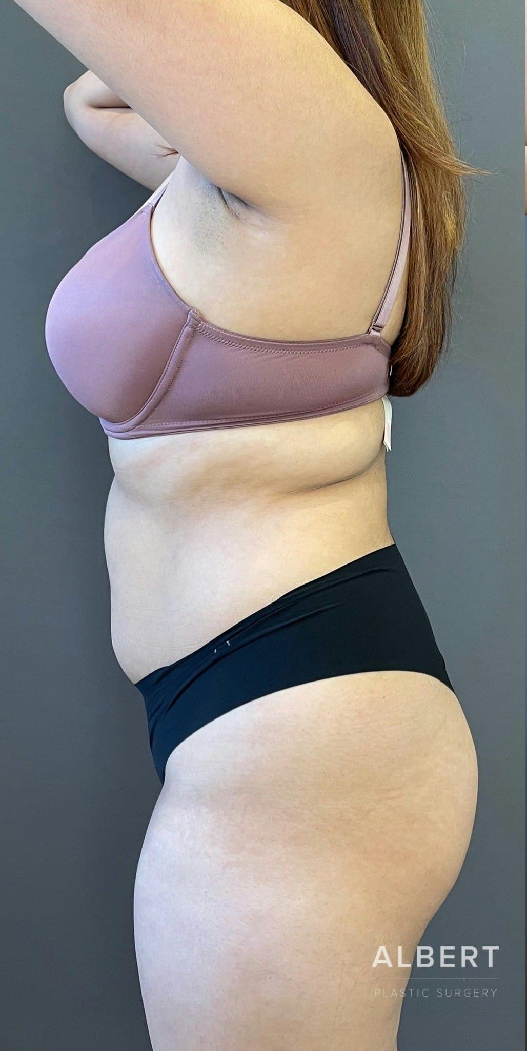 Liposuction Before & After Gallery - Patient 151452145 - Image 5