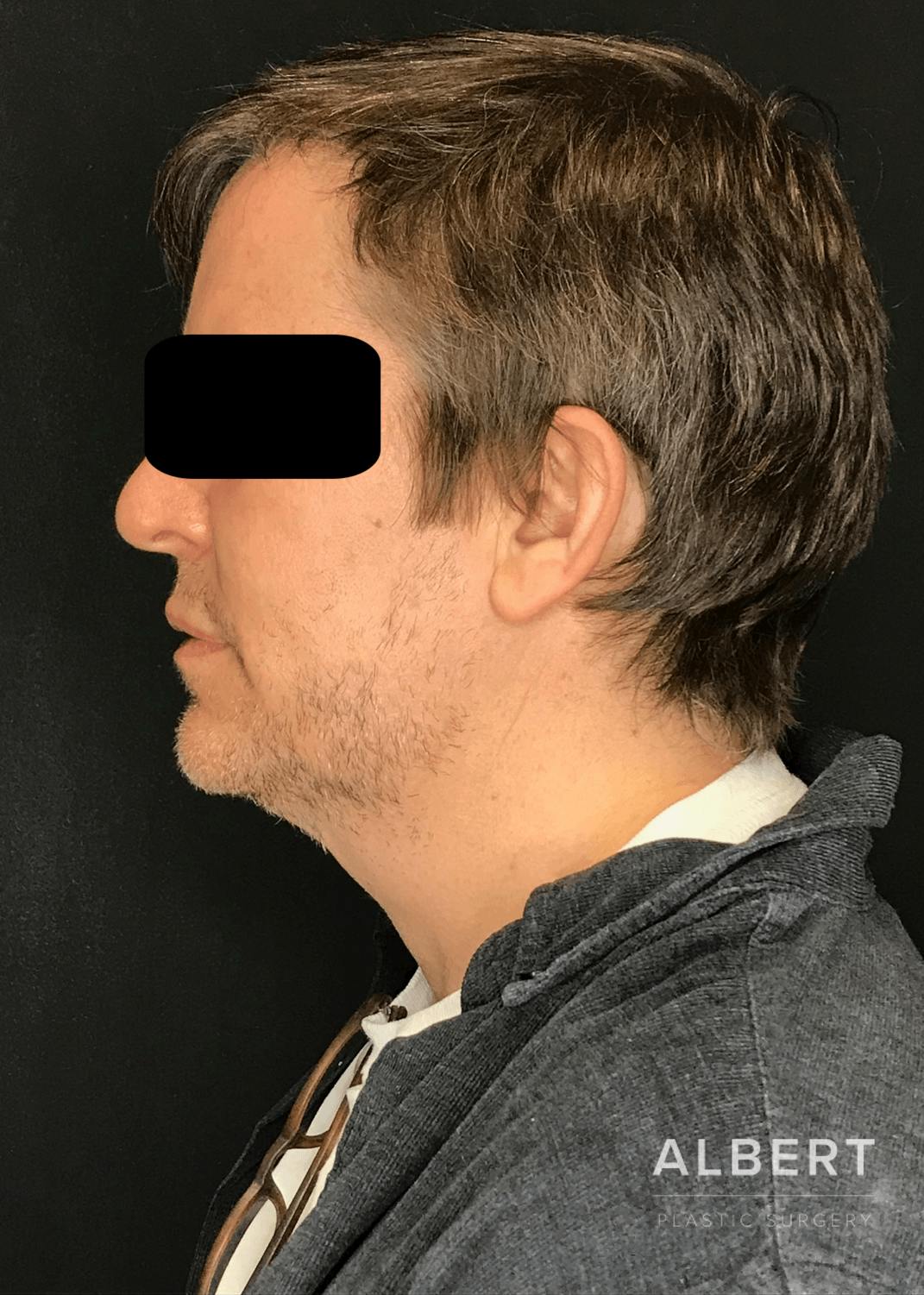 Liposuction Before & After Gallery - Patient 384585 - Image 3