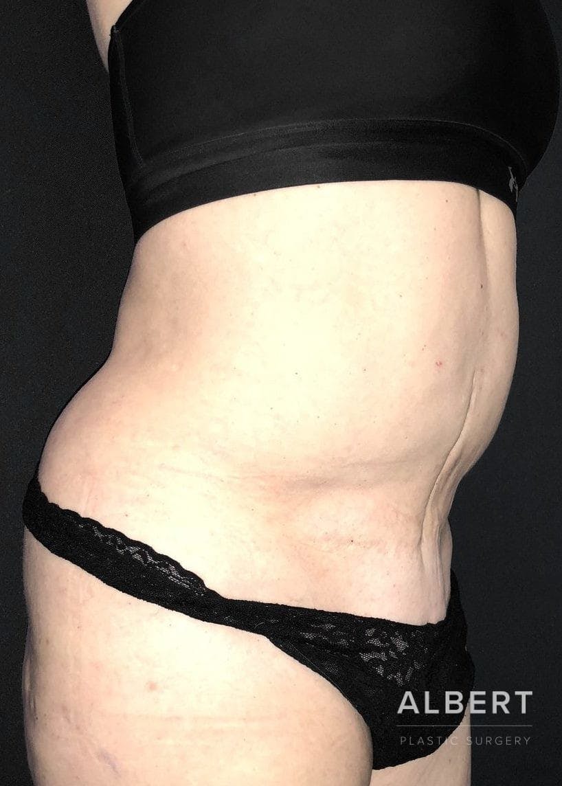Liposuction Before & After Gallery - Patient 151452155 - Image 7