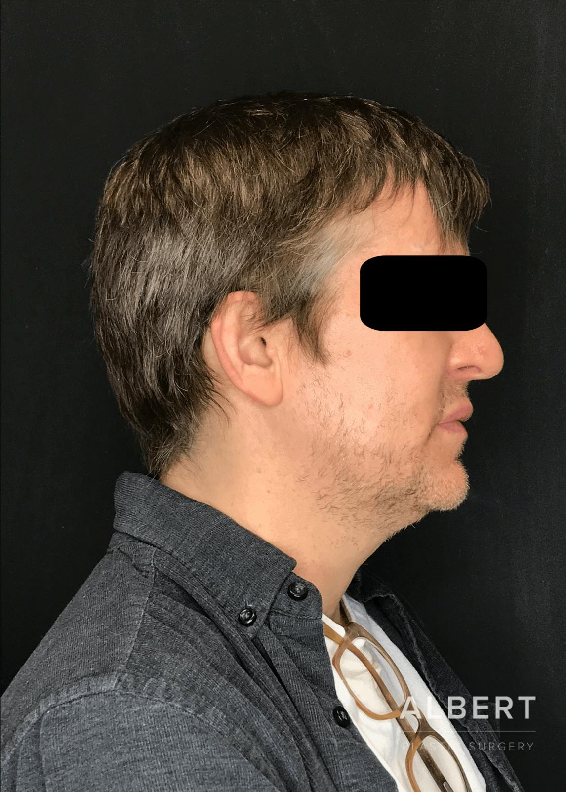 Liposuction Before & After Gallery - Patient 384585 - Image 5