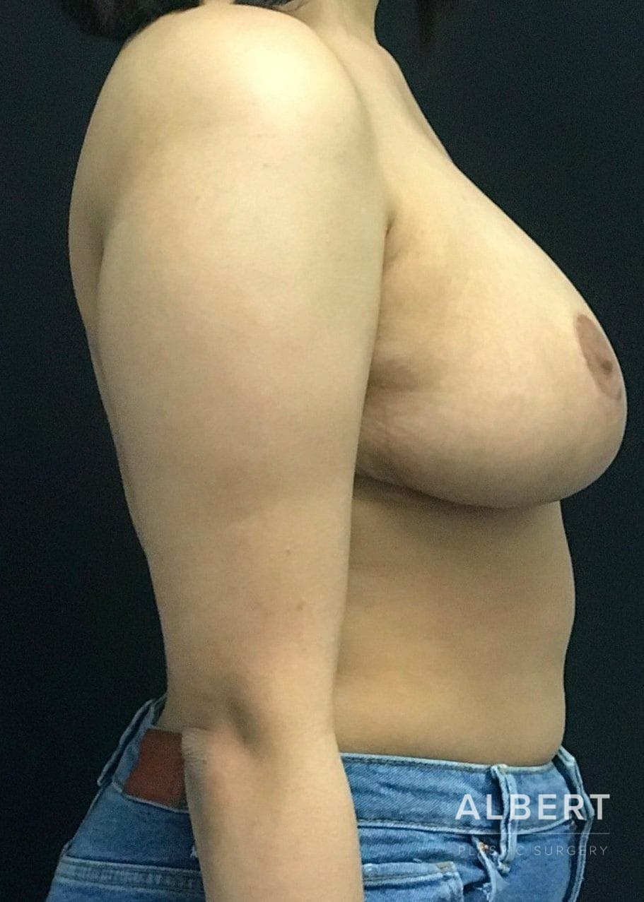 Breast Lift / Reduction Before & After Gallery - Patient 151362535 - Image 10
