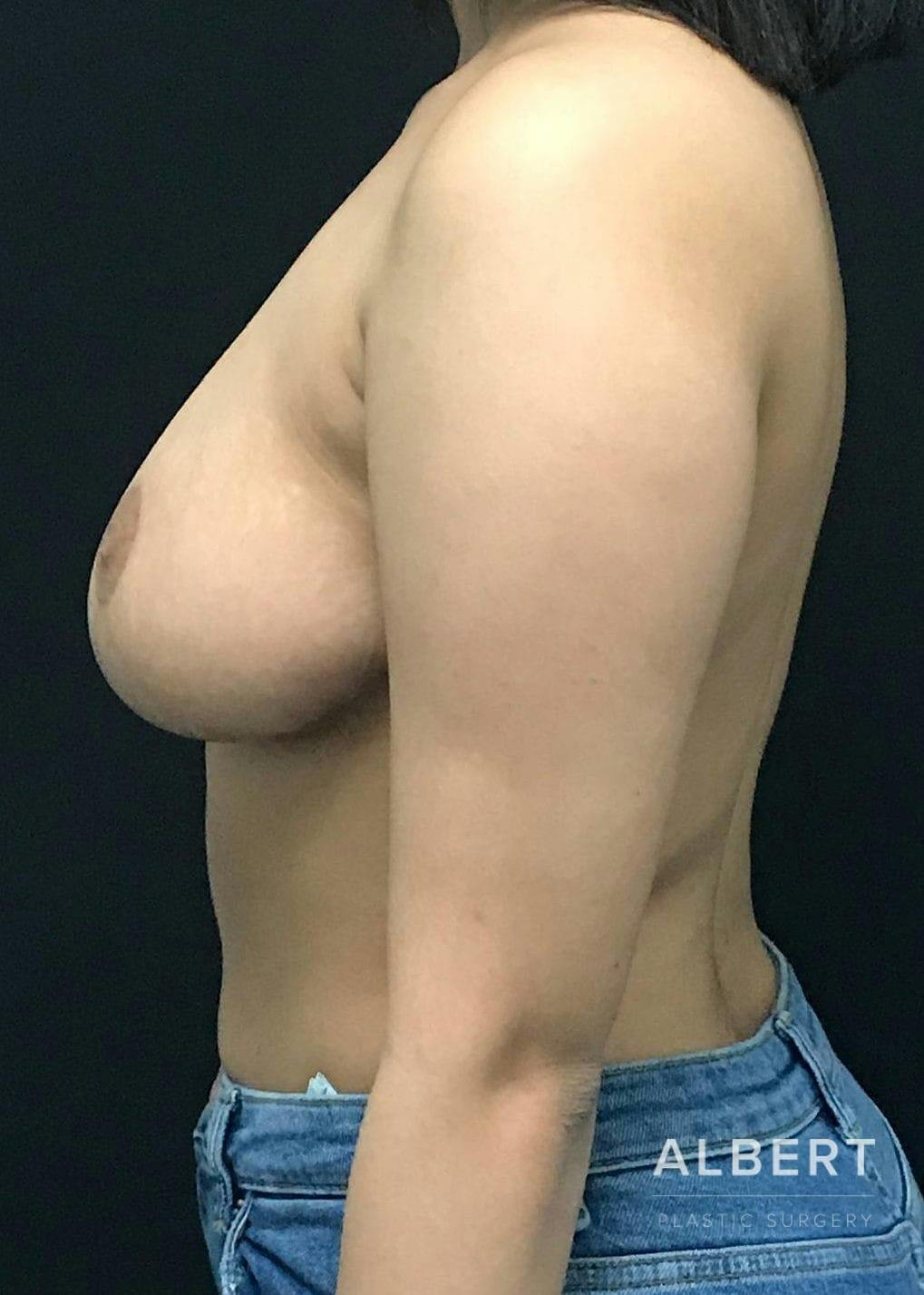 Breast Lift / Reduction Before & After Gallery - Patient 151362535 - Image 6