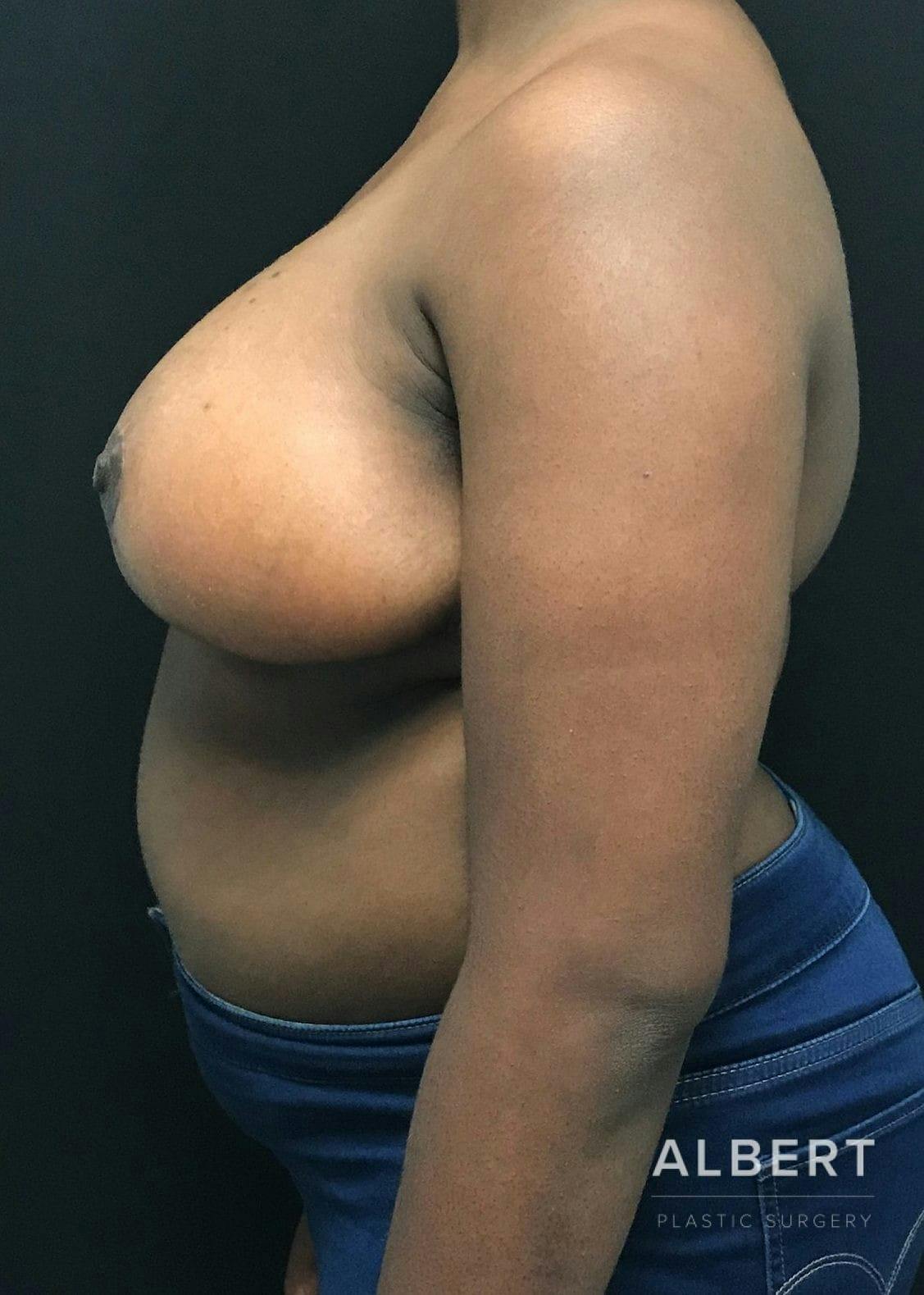 Breast Lift / Reduction Before & After Gallery - Patient 151362539 - Image 8