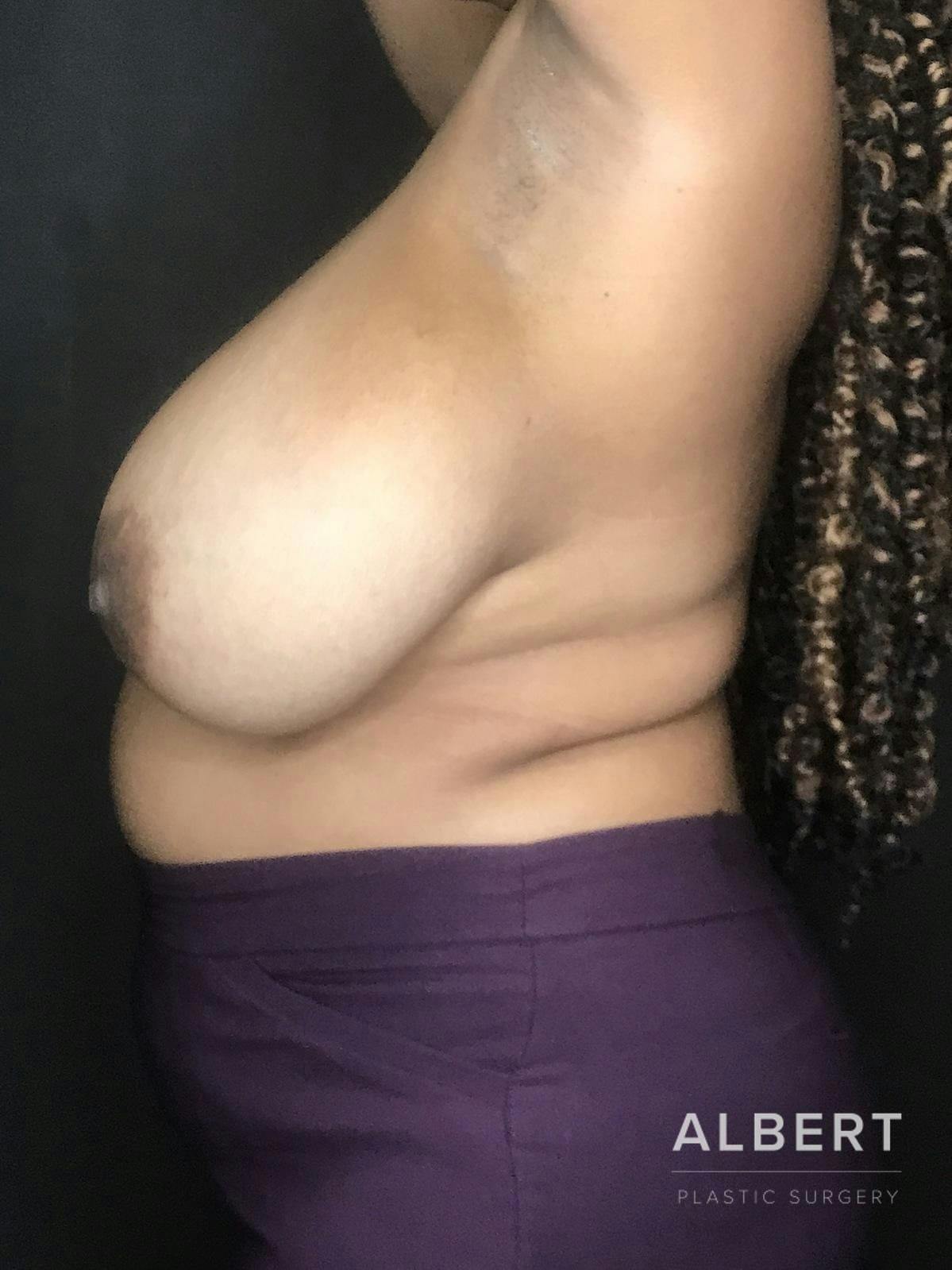 Breast Lift / Reduction Before & After Gallery - Patient 151362551 - Image 3