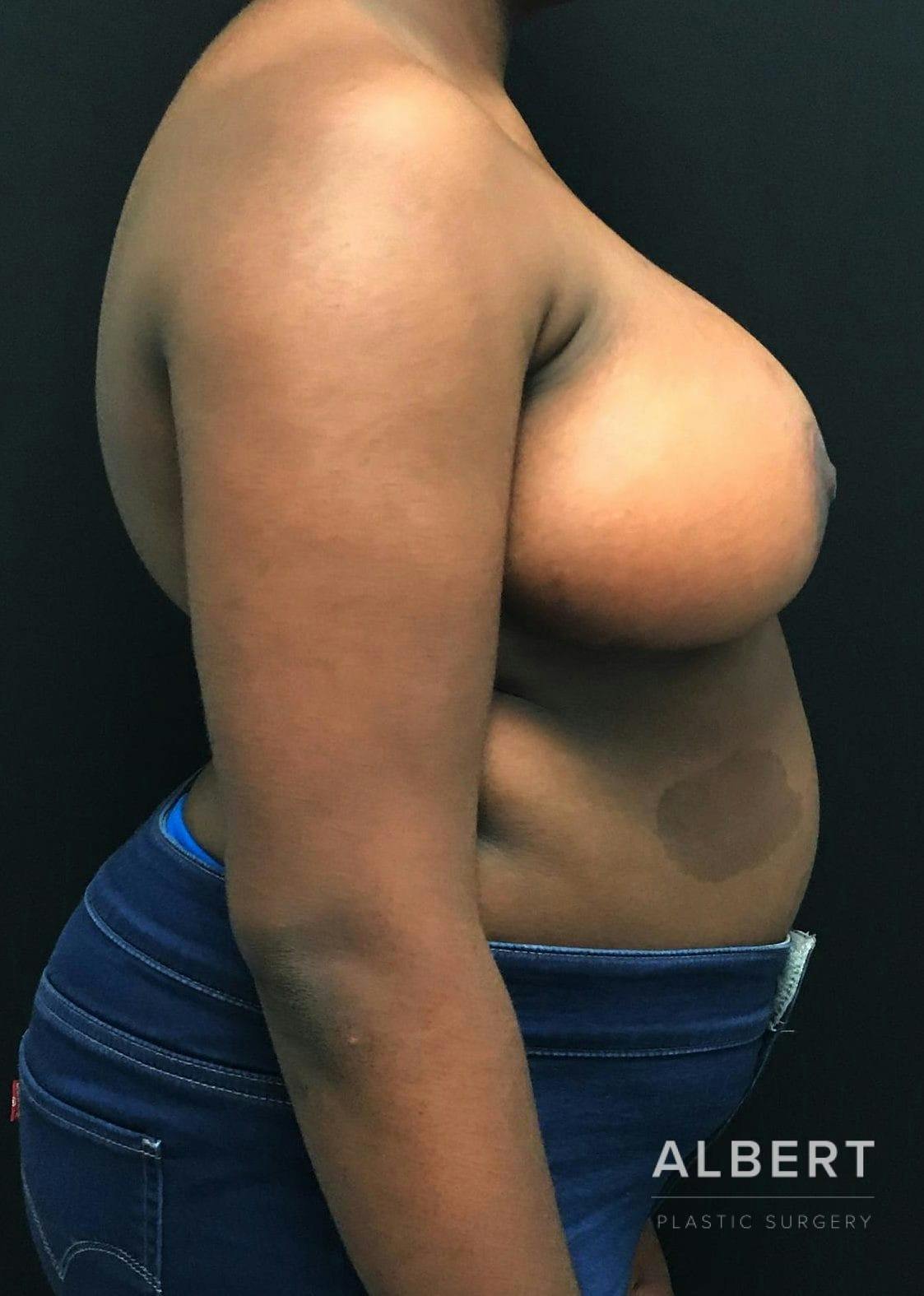 Breast Lift / Reduction Before & After Gallery - Patient 151362539 - Image 10