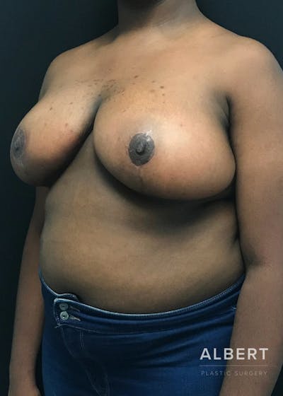 Breast Lift / Reduction Before & After Gallery - Patient 151362539 - Image 2