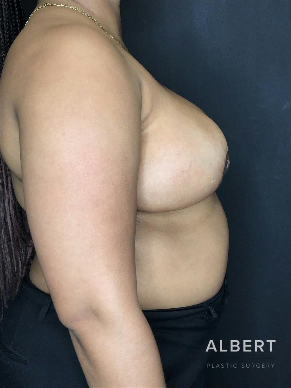 Breast Lift / Reduction Before & After Gallery - Patient 151362551 - Image 2