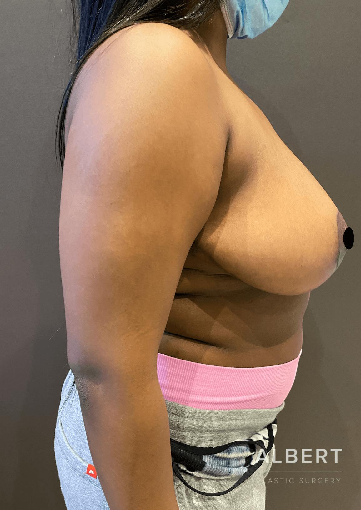 Breast Lift / Reduction Before & After Gallery - Patient 151362553 - Image 4