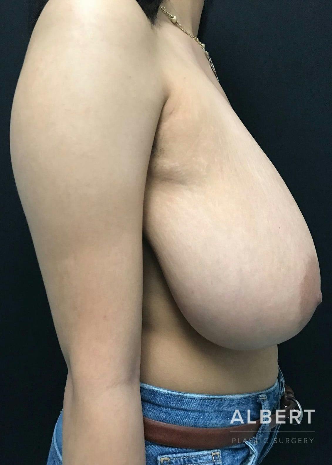 Breast Lift / Reduction Before & After Gallery - Patient 151362535 - Image 9
