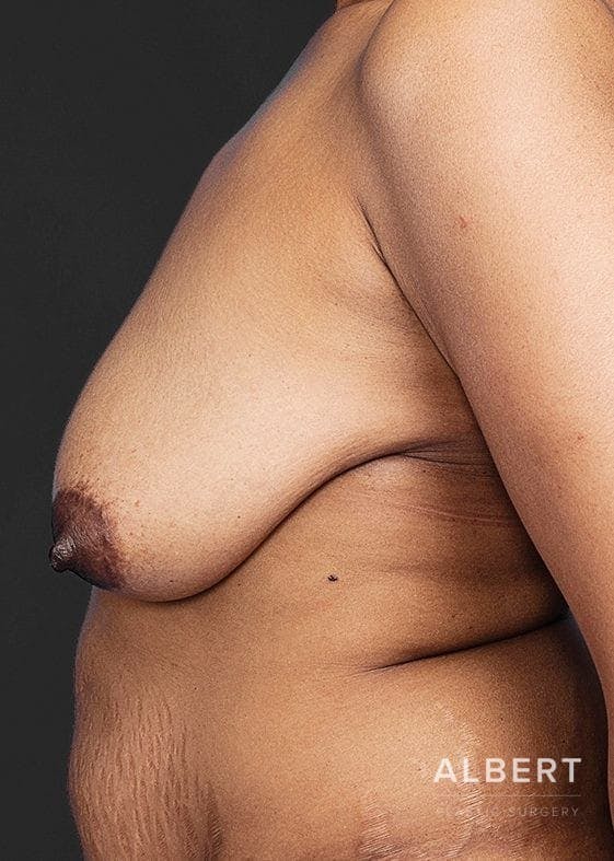 Breast Lift / Reduction Before & After Gallery - Patient 151362538 - Image 7