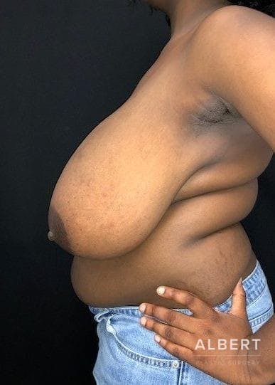 Breast Lift / Reduction Before & After Gallery - Patient 151362539 - Image 7