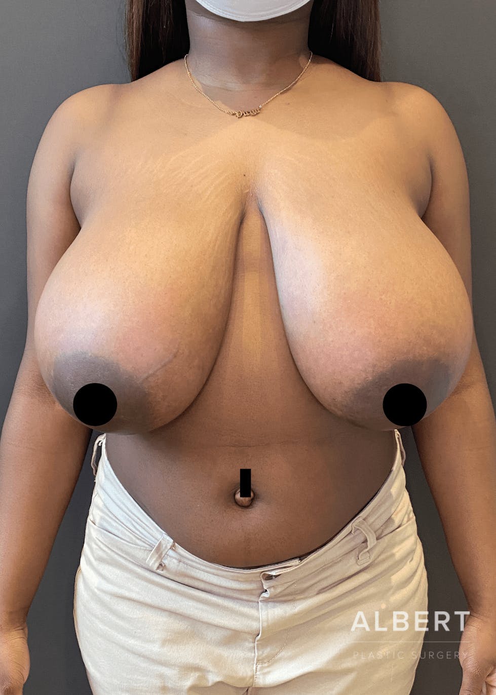 Breast Lift / Reduction Before & After Gallery - Patient 151362553 - Image 1