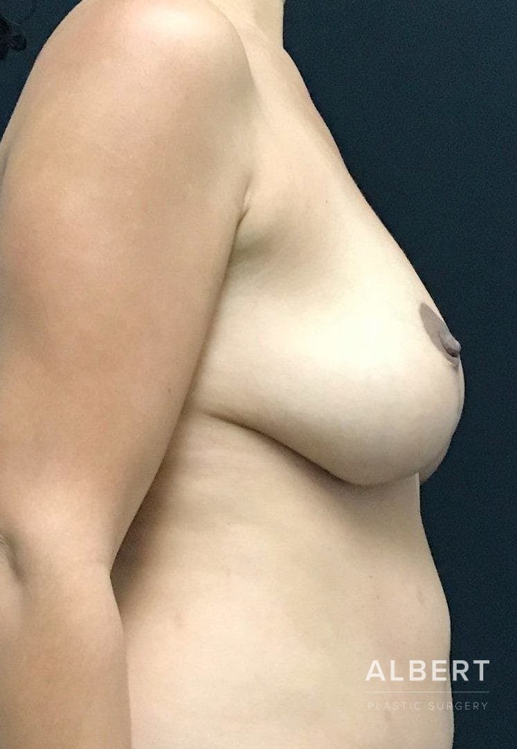 Breast Lift / Reduction Before & After Gallery - Patient 151362554 - Image 6