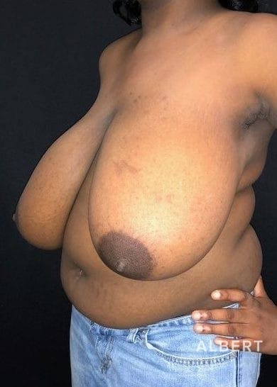 Breast Lift / Reduction Before & After Gallery - Patient 151362539 - Image 5