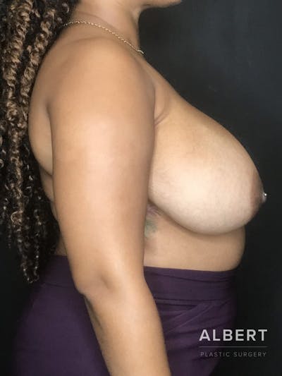 Breast Lift / Reduction Before & After Gallery - Patient 151362551 - Image 1
