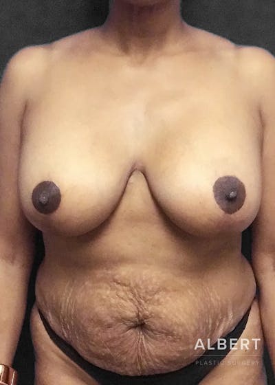 Breast Lift / Reduction Before & After Gallery - Patient 151362538 - Image 2