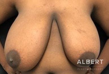 Breast Lift / Reduction Before & After Gallery - Patient 151362539 - Image 3