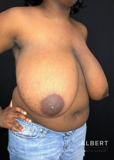 Breast Lift / Reduction Before & After Gallery - Patient 151362539 - Image 3
