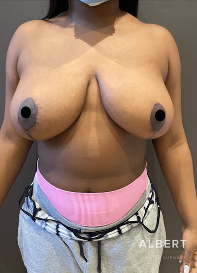 Breast Lift / Reduction Before & After Gallery - Patient 151362553 - Image 2