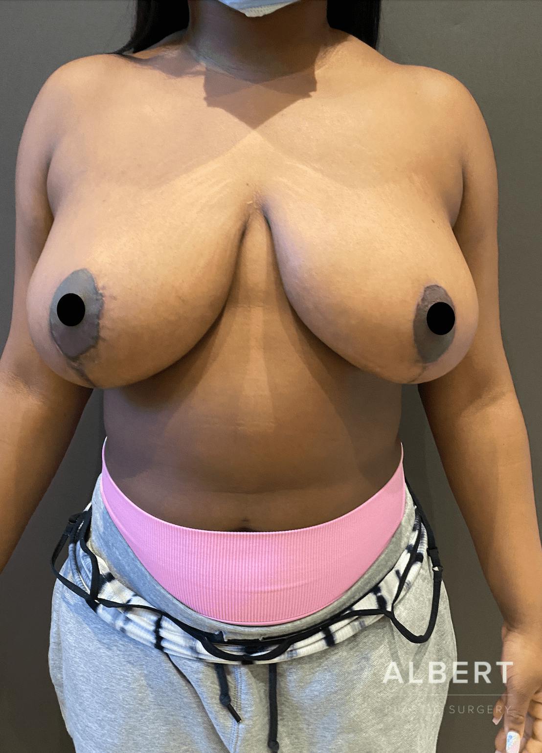 Breast Lift / Reduction Before & After Gallery - Patient 151362553 - Image 2
