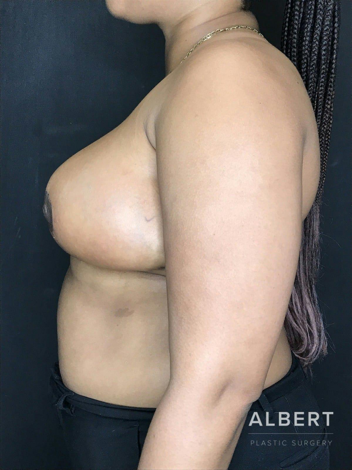 Breast Lift / Reduction Before & After Gallery - Patient 151362551 - Image 4