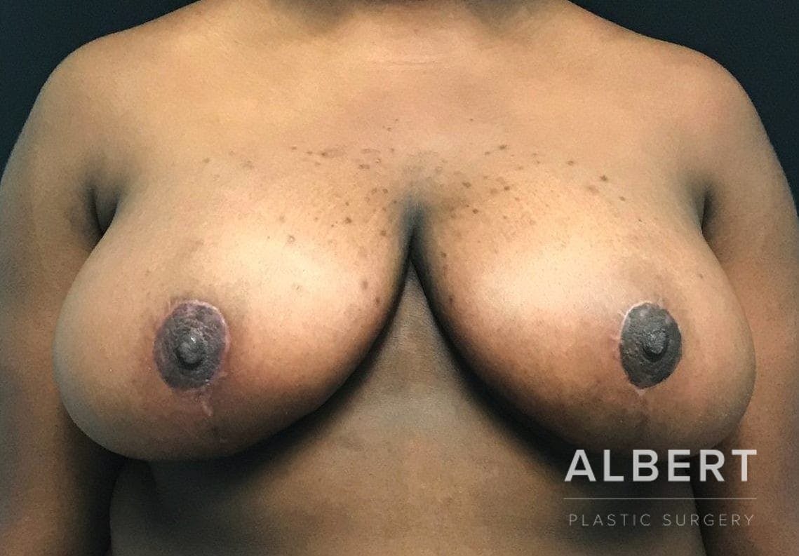 Breast Lift / Reduction Before & After Gallery - Patient 151362539 - Image 4