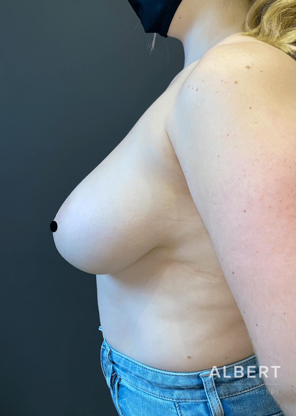 Breast Lift / Reduction Before & After Gallery - Patient 151362552 - Image 1