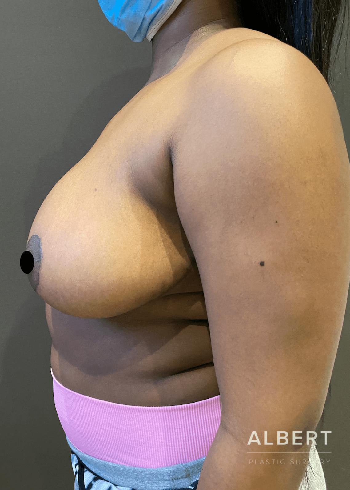 Breast Lift / Reduction Before & After Gallery - Patient 151362553 - Image 6