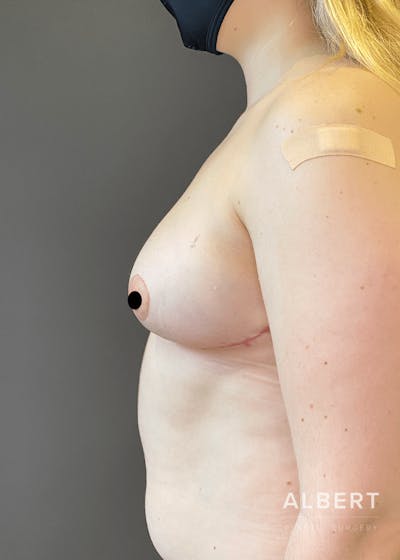 Breast Lift / Reduction Before & After Gallery - Patient 151362552 - Image 2