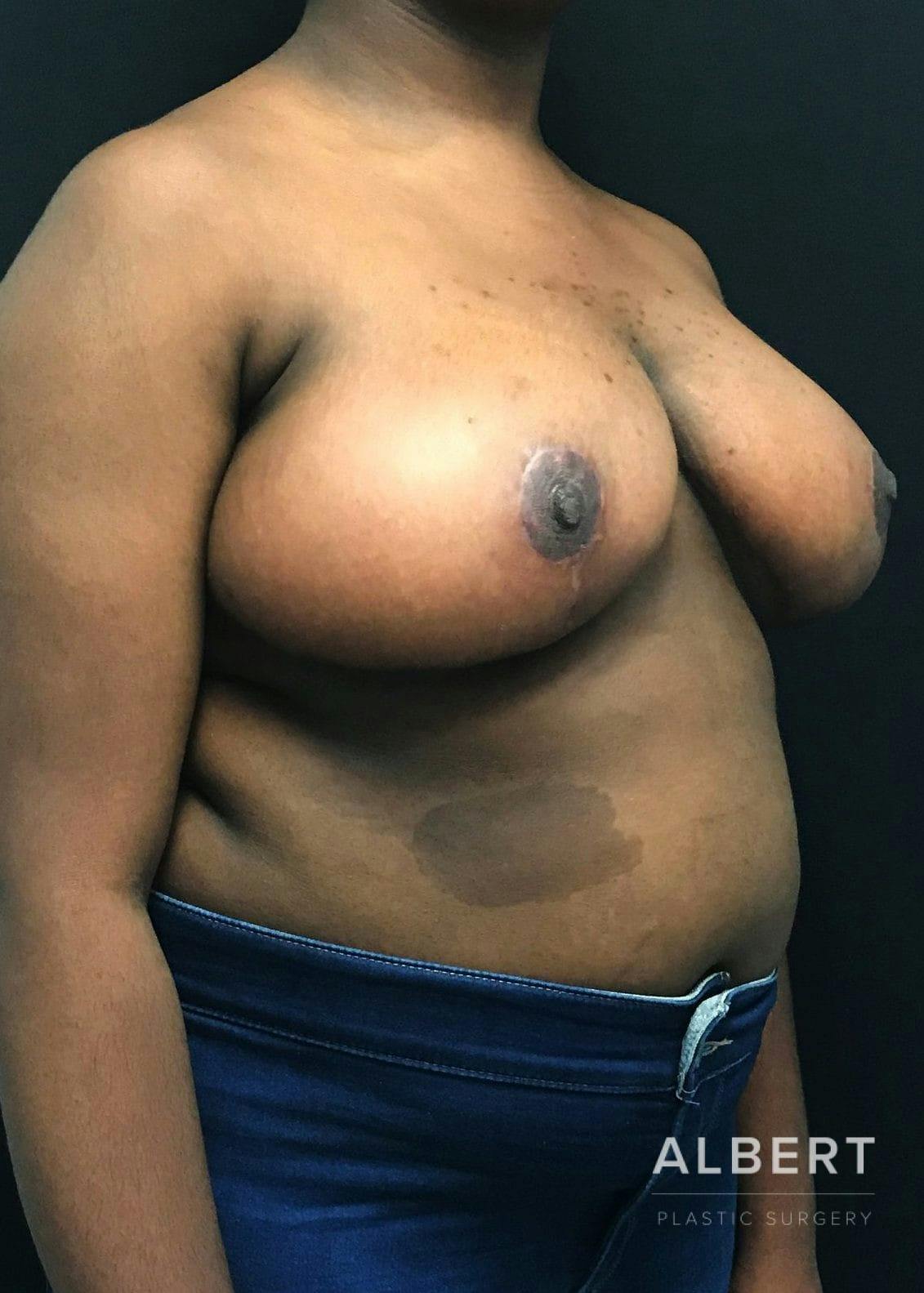 Breast Lift / Reduction Before & After Gallery - Patient 151362539 - Image 4